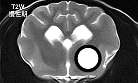 【慢性期、T2強調画像】