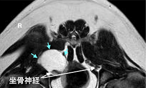 【MRI、病変部の横断像、T2強調画像】