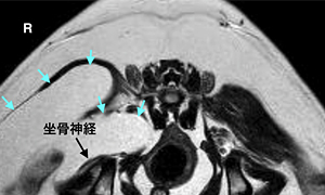 【MRI、横断像、T2強調画像】