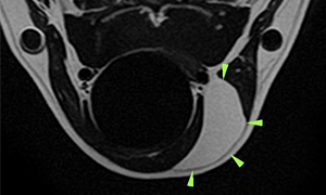 【MRI、横断像、T2強調画像】