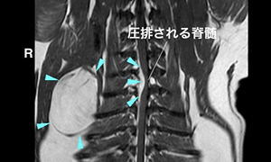 【MRI、背断像、T1強調画像】