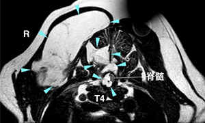 【MRI、横断像、T2強調画像】