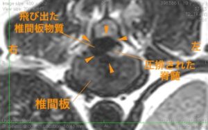 ＜MR画像 横断像(T11-12)＞