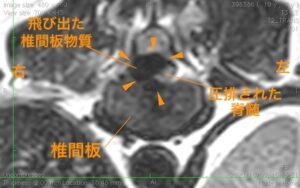 <MR画像 横断像(T11-12)>