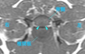 [MR画像 病変部の横断像 T1強調画像]