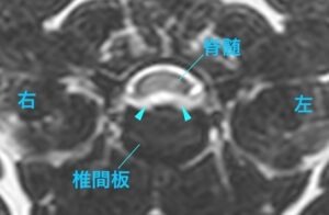 [MR画像 病変部の横断像 T2強調画像]