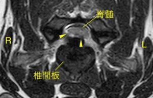 [横断像 T2強調画像　一般的な椎間板ヘルニア(Ⅰ型)の場合]