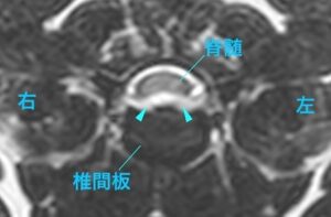 [本症例 病変部の横断像 T2強調画像]