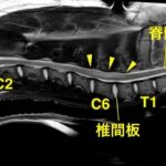 [右：MRI画像 頸部矢状断像]