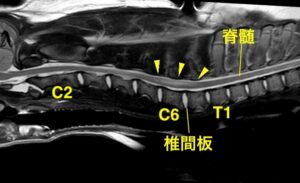[右：MRI画像 頸部矢状断像]