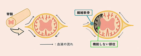繊維軟骨塞栓症（FCE)