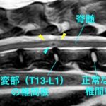 [MR画像 胸腰部矢状断像 T2強調画像]