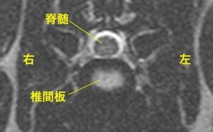 [MR画像 横断像(正常)] 