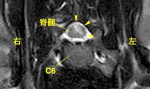 [左：MRI画像 病変部横断像]