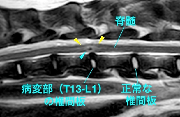 [MR画像 胸腰部矢状断像 T2強調画像]