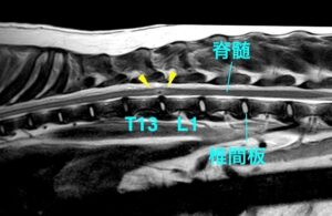 [MR画像 胸腰部矢状断像 T2強調画像]