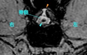 [横断像(T13-L1) T2＊強調画像]