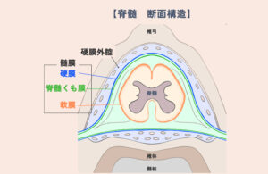硬膜内 / 髄内椎間板逸脱（IIVDE）