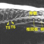 [胸部矢状断像 T2強調画像]
