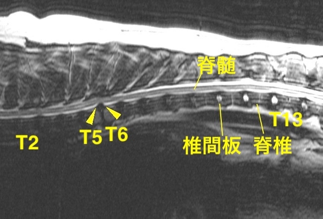 [胸部矢状断像 T2強調画像]