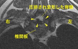 [C5-6横断像 T2強調画像]