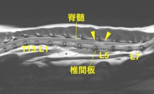 [腰部矢状断像T2強調画像] 