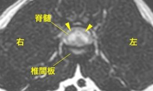 [MR画像 病変部の横断像 T2強調画像]