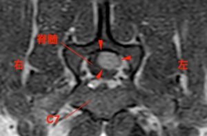 [MRI、横断像（T7）、造影T1強調画像]