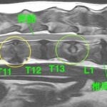 【MRI、胸腰部矢状断像、T2強調画像】