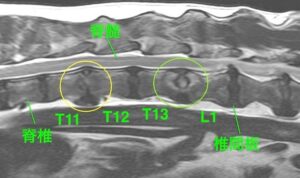 【MRI、胸腰部矢状断像、T2強調画像】 