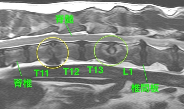 【MRI、胸腰部矢状断像、T2強調画像】
