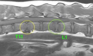 【MRI、胸腰部矢状断像、T1強調画像】