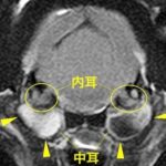 【MRI、内耳/中耳レベル画像】
