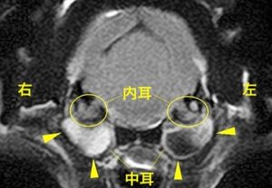 【MRI、内耳／中耳レベル画像】