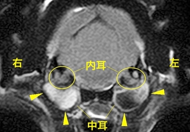 【MRI、内耳/中耳レベル画像】