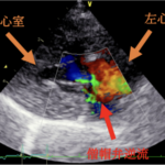 #1 粘液腫様僧帽弁疾患ステージB2