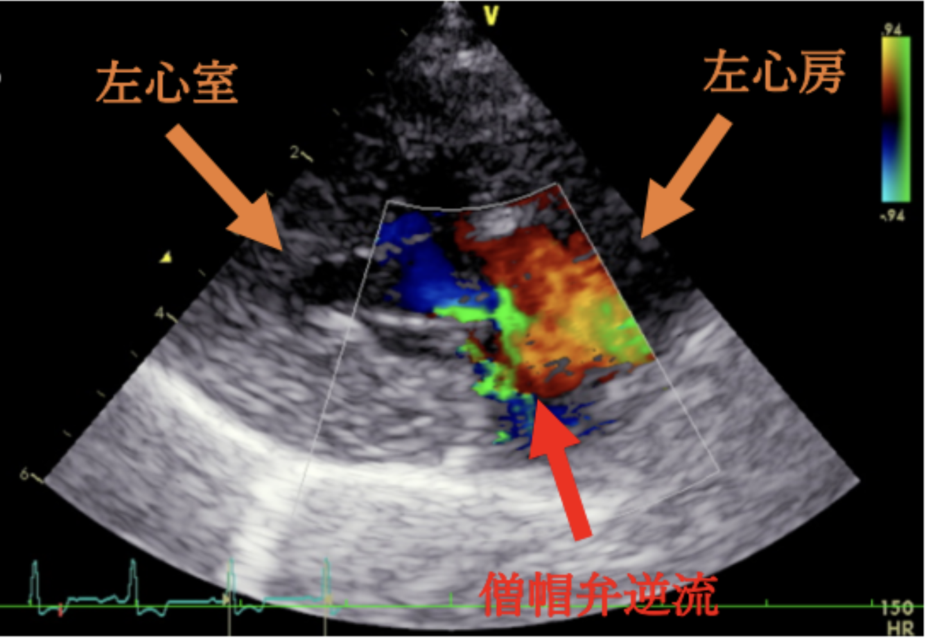 #1 粘液腫様僧帽弁疾患ステージB2