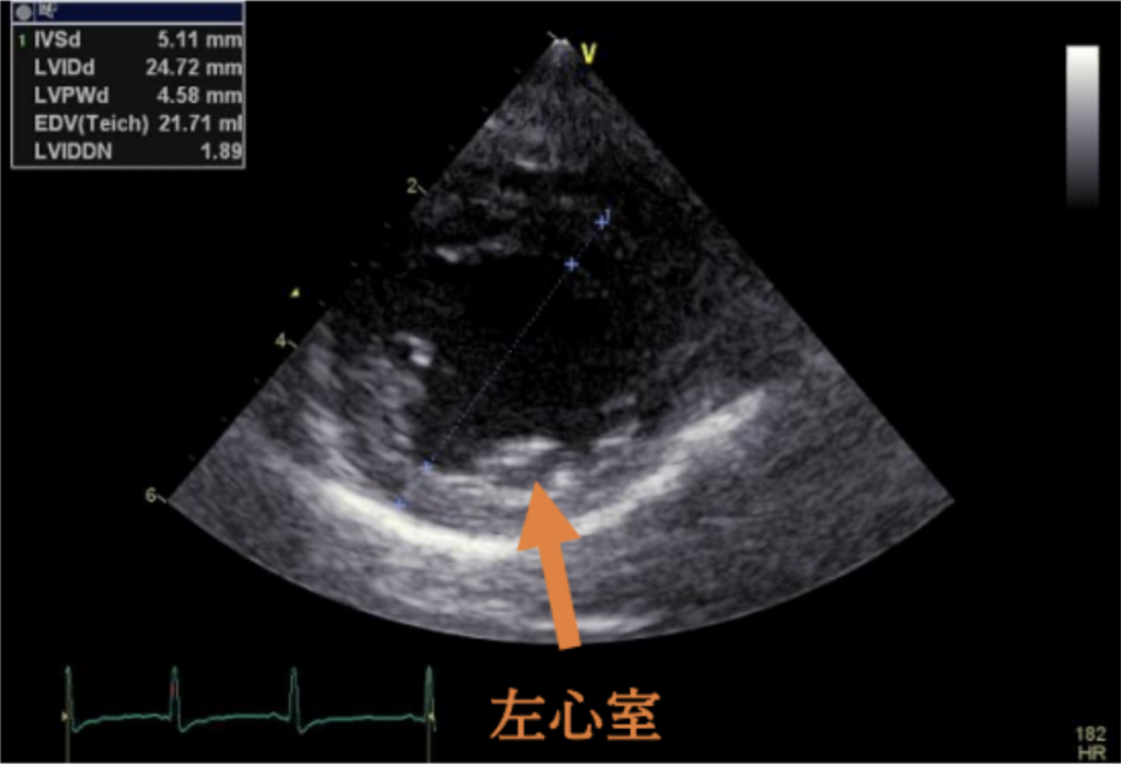 #1 粘液腫様僧帽弁疾患ステージB2