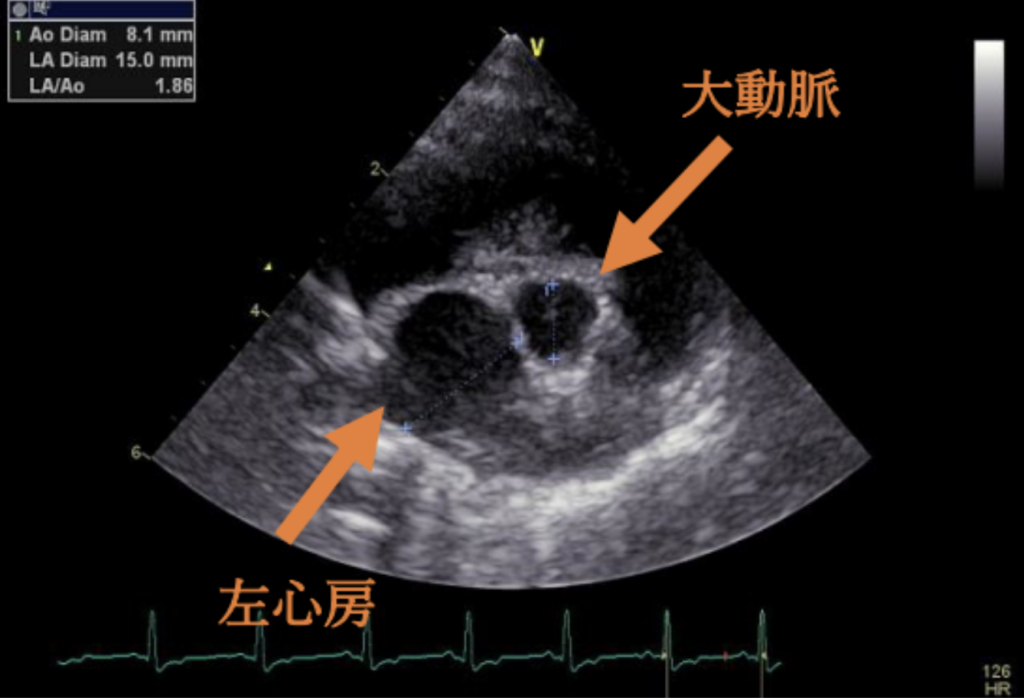 #1 粘液腫様僧帽弁疾患ステージB2