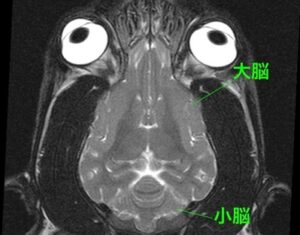 【MRI、背断像、T2強調画像】