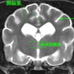 [横断像(本症例)、T2強調画像]