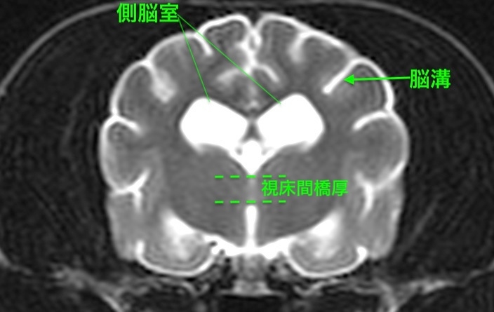 [横断像(本症例)、T2強調画像]
