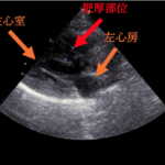 ＃2 閉塞性肥大型心筋症ステージB1
