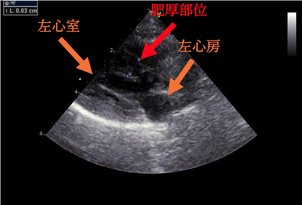 #2 閉塞性肥大型心筋症ステージB1