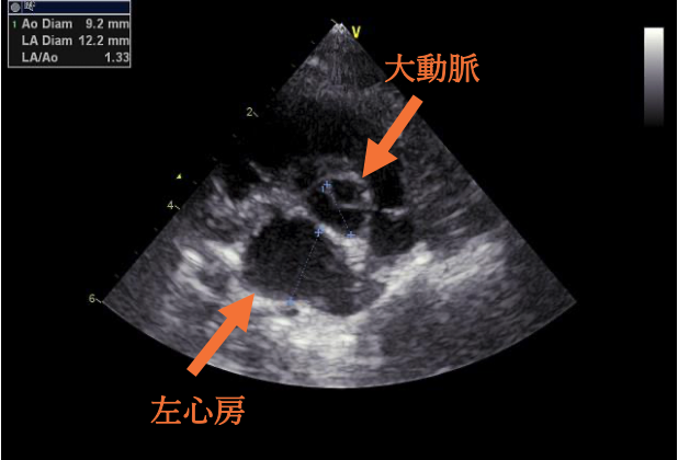 #2 閉塞性肥大型心筋症ステージB1