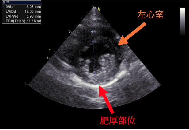 #2 閉塞性肥大型心筋症ステージB1
