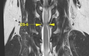 [MR画像 背断像 T2強調画像]