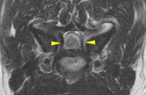 [MR画像 横断像(C5-6) T2強調画像]