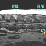 【MRI、胸腰部矢状断像、T2強調画像】
