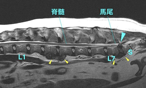 【MRI、胸腰部矢状断像、T2強調画像】
